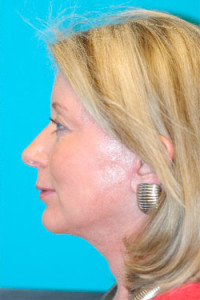 Facelift and Necklift Before and After Photos