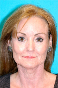 Facelift and Necklift Before and After Photos Case 3782 Before Photo Facelift and Necklift Before and After Photos