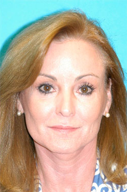 Facelift and Necklift Before and After Photos Case 3782 After Photo Facelift and Necklift Before and After Photos