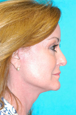 Facelift and Necklift Before and After Photos Case 3782 After Photo Facelift and Necklift Before and After Photos