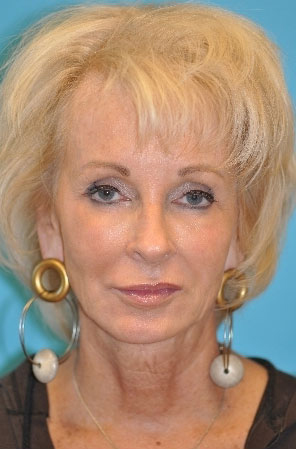 Facelift and Necklift Before and After Photos Case 3818 Before Photo Facelift and Necklift Before and After Photos