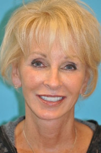 Facelift and Necklift Before and After Photos