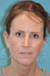 Facelift and Necklift Before and After Photos