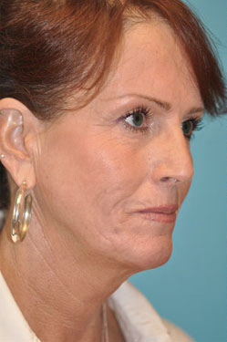 Facelift and Necklift Before and After Photos Case 3845 Before Photo Facelift and Necklift Before and After Photos