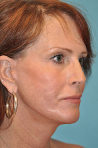 Facelift and Necklift Before and After Photos