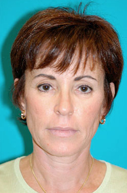 Facelift and Necklift Before and After Photos Case 3867 Before Photo Facelift and Necklift Before and After Photos