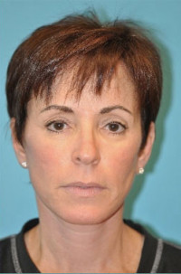 Facelift and Necklift Before and After Photos
