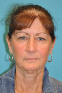 Facelift and Necklift Before and After Photos