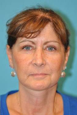 Facelift and Necklift Before and After Photos