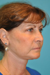 Facelift and Necklift Before and After Photos
