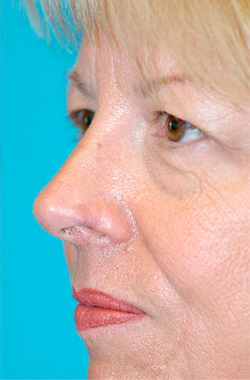 Skin Cancer Reconstruction Before and After Photos