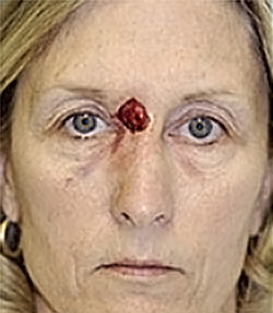 Skin Cancer Reconstruction Before and After Photos