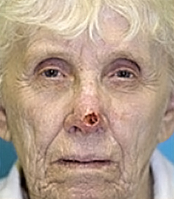 Skin Cancer Reconstruction Before and After Photos Case 3579 Before Photo Skin Cancer Reconstruction Before and After Photos