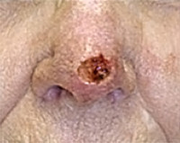 Skin Cancer Reconstruction Before and After Photos