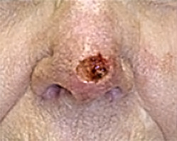 Skin Cancer Reconstruction Before and After Photos Case 3579 Before Photo Skin Cancer Reconstruction Before and After Photos