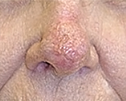 Skin Cancer Reconstruction Before and After Photos Case 3579 After Photo Skin Cancer Reconstruction Before and After Photos