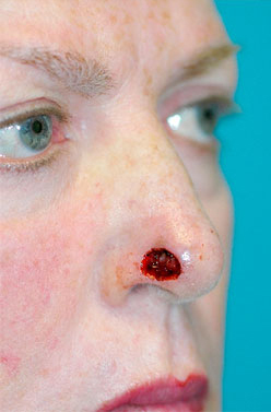 Skin Cancer Reconstruction Before and After Photos Case 3621 Before Photo Skin Cancer Reconstruction Before and After Photos
