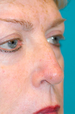 Skin Cancer Reconstruction Before and After Photos
