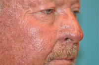 Skin Cancer Reconstruction Before and After Photos