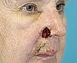 Skin Cancer Reconstruction Before and After Photos