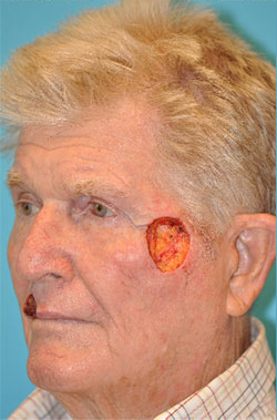 Skin Cancer Reconstruction Before and After Photos