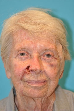 Skin Cancer Reconstruction Before and After Photos Case 3803 Before Photo Skin Cancer Reconstruction Before and After Photos
