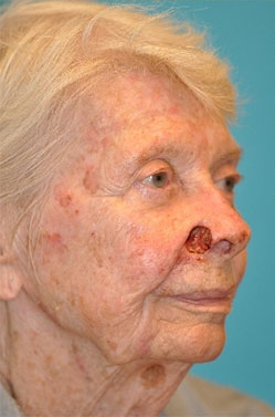 Skin Cancer Reconstruction Before and After Photos Case 3803 Before Photo Skin Cancer Reconstruction Before and After Photos