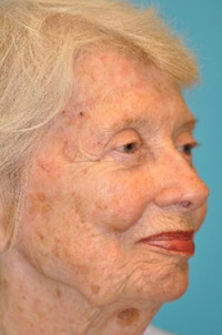 Skin Cancer Reconstruction Before and After Photos