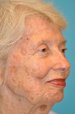 Skin Cancer Reconstruction Before and After Photos Case 3803 After Photo Skin Cancer Reconstruction Before and After Photos