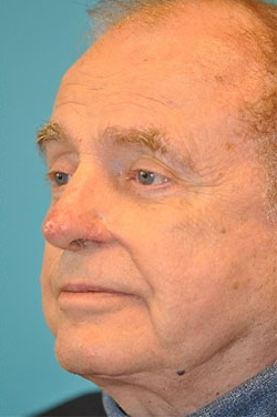 Skin Cancer Reconstruction Before and After Photos