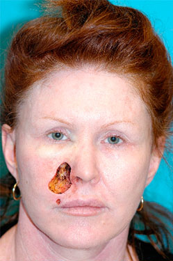Skin Cancer Reconstruction Before and After Photos Case 3848 Before Photo Skin Cancer Reconstruction Before and After Photos