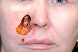 Skin Cancer Reconstruction Before and After Photos Case 3848 Before Photo Skin Cancer Reconstruction Before and After Photos