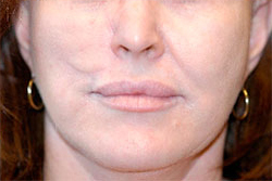 Skin Cancer Reconstruction Before and After Photos Case 3848 After Photo Skin Cancer Reconstruction Before and After Photos