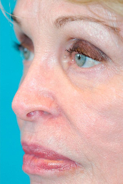 Skin Cancer Reconstruction Before and After Photos