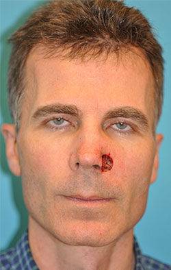 Skin Cancer Reconstruction Before and After Photos Case 3888 Before Photo Skin Cancer Reconstruction Before and After Photos