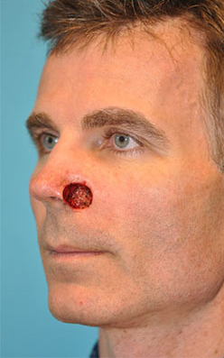 Skin Cancer Reconstruction Before and After Photos Case 3888 Before Photo Skin Cancer Reconstruction Before and After Photos