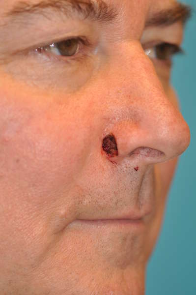 Skin Cancer Reconstruction Before and After Photos Case 3906 Before Photo Skin Cancer Reconstruction Before and After Photos