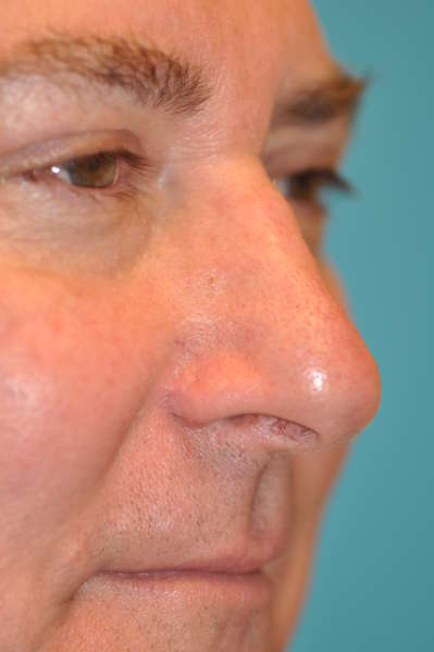 Skin Cancer Reconstruction Before and After Photos Case 3906 After Photo Skin Cancer Reconstruction Before and After Photos