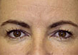 Upper Blepharoplasty (Eyelid)