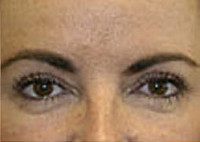 Upper Blepharoplasty (Eyelid)