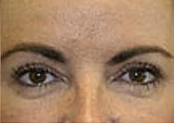 Upper Blepharoplasty (Eyelid) Before and After Photos