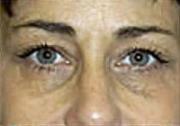 Upper Blepharoplasty (Eyelid) Before and After Photos