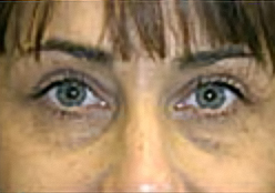 Upper Blepharoplasty (Eyelid) Before and After Photos