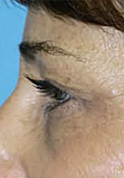 Upper Blepharoplasty (Eyelid) Before and After Photos