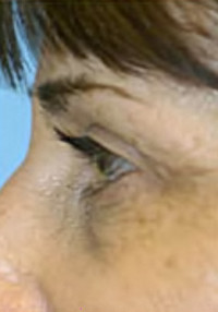 Upper Blepharoplasty (Eyelid) Before and After Photos