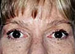 Upper Blepharoplasty (Eyelid) Before and After Photos Case 3530 After Photo Upper Blepharoplasty (Eyelid) Before and After Photos
