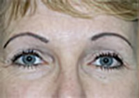 Upper Blepharoplasty (Eyelid) Before and After Photos