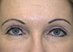 Upper Blepharoplasty (Eyelid) Before and After Photos