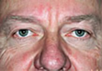 Upper Blepharoplasty (Eyelid)