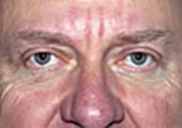 Upper Blepharoplasty (Eyelid) Before and After Photos